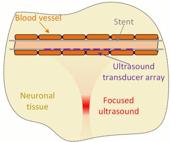Stent with Piezoelectric Transducers for High Spatial Resolution Ultrasound Neuromodulation- a Finite Element Analysis